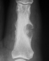 /album/a1/epidermoide-ii-png/